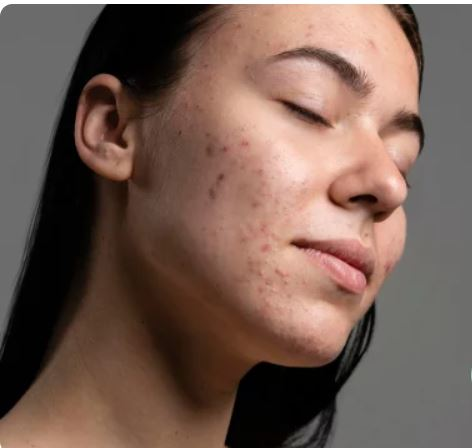 zhensko litse s akne